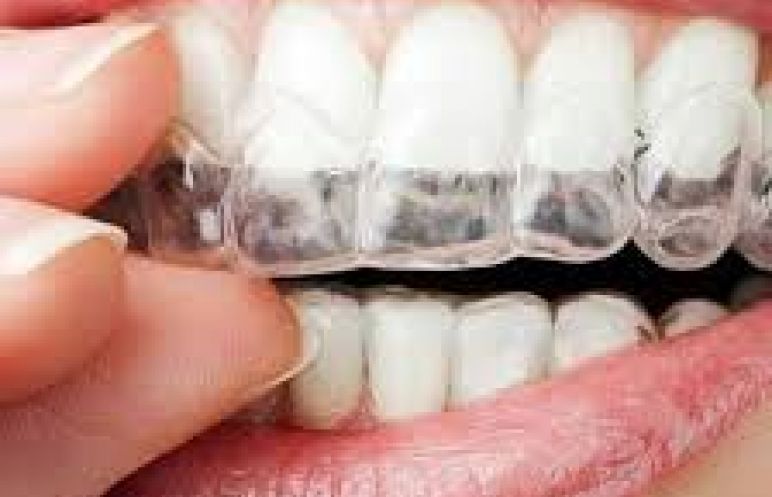 Şeffaf Plaklar ile Telsiz Ortodonti